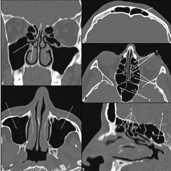 CT PNS (Para Nasal Sinus)