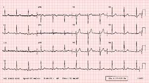 ECG At Home